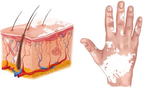 金华手部白癜风出现扩散该怎么办呢
